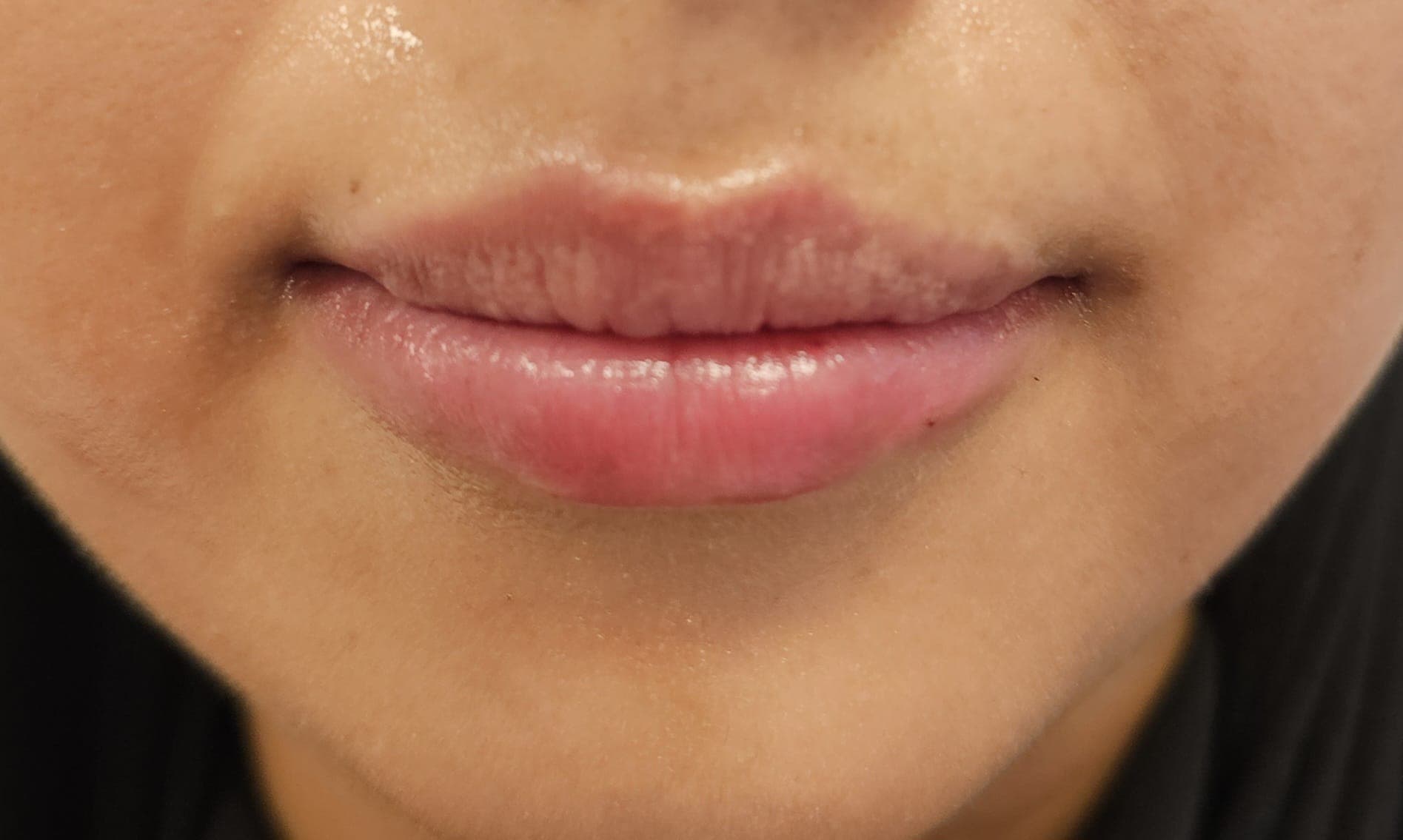 Lippen nach Filler-Behandlung — natürliche Volumenkorrektur