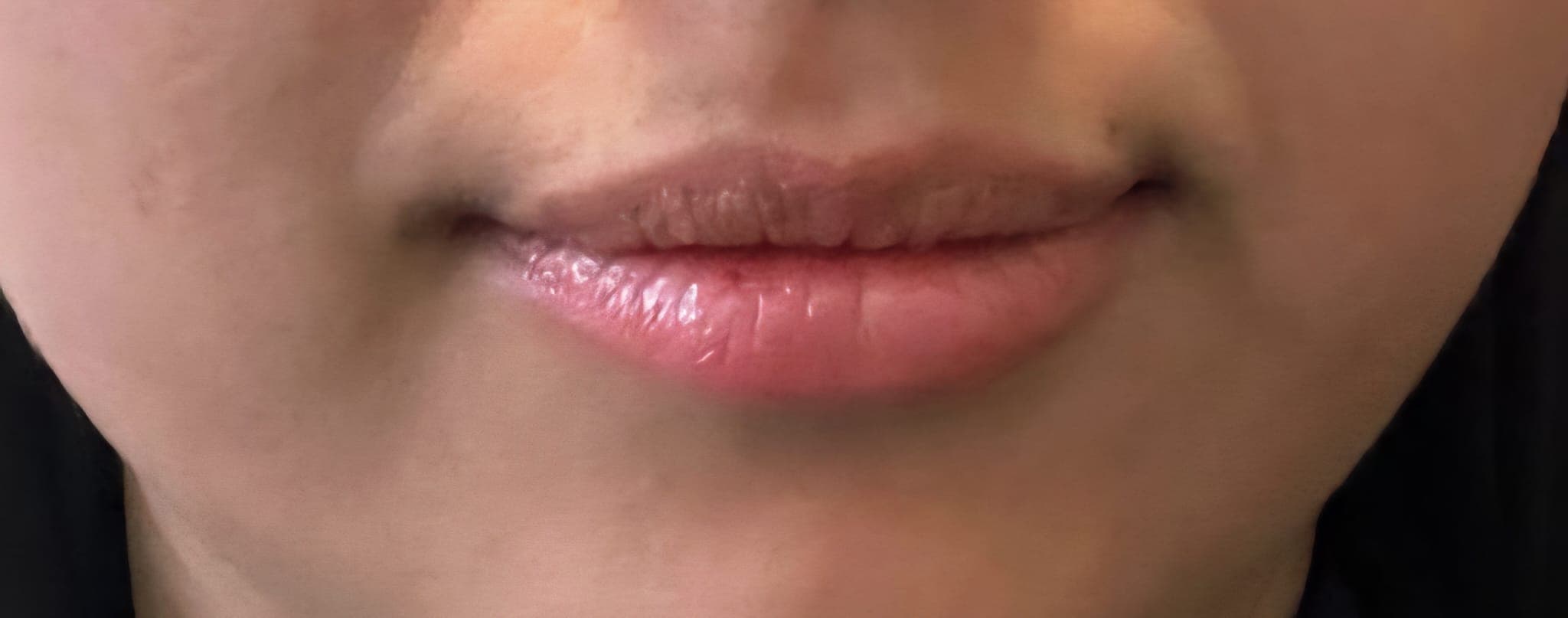 Lippen vor Filler-Behandlung — Ausgangszustand