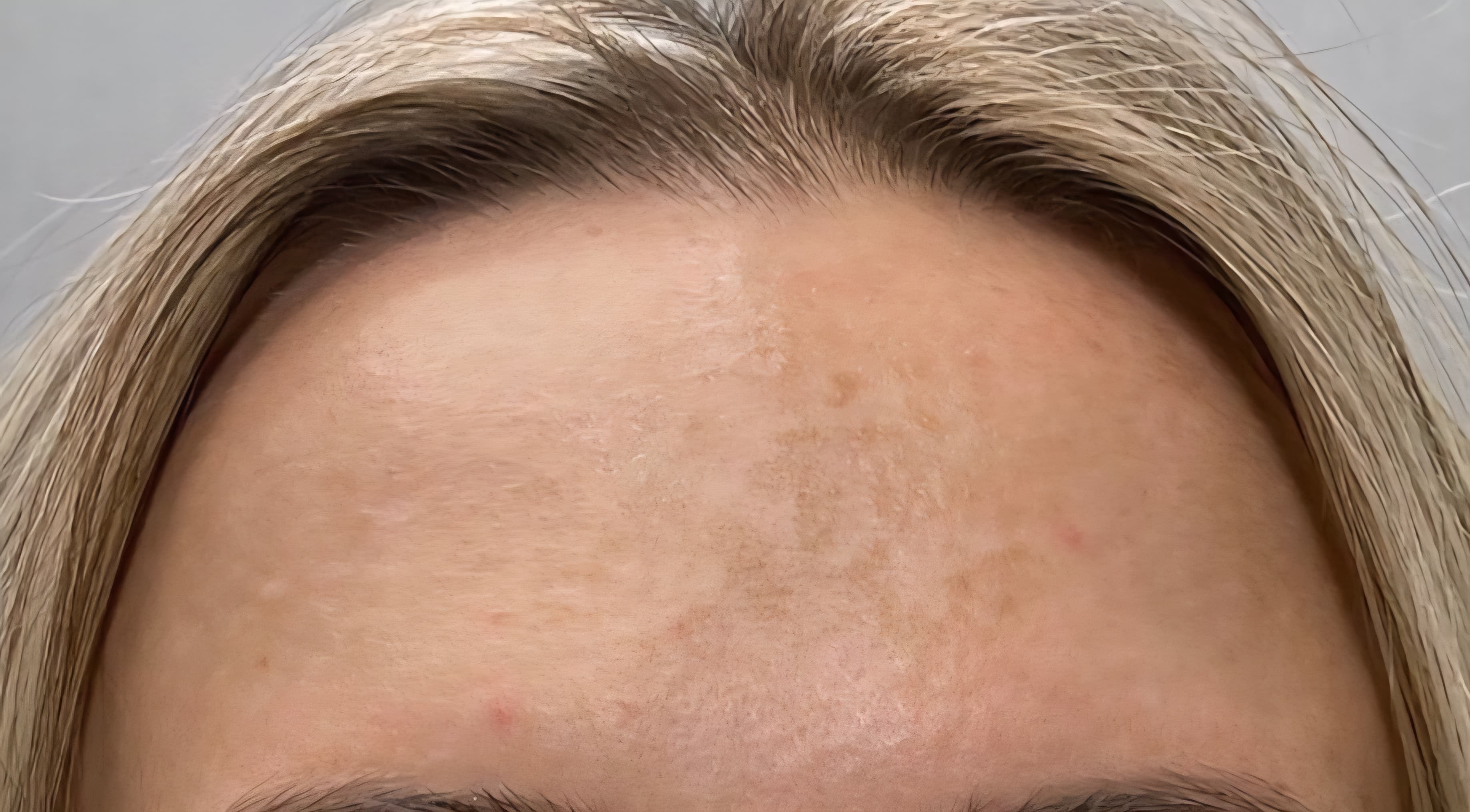 Stirn nach Botulinumtoxin-Behandlung — geglättete Hautoberfläche