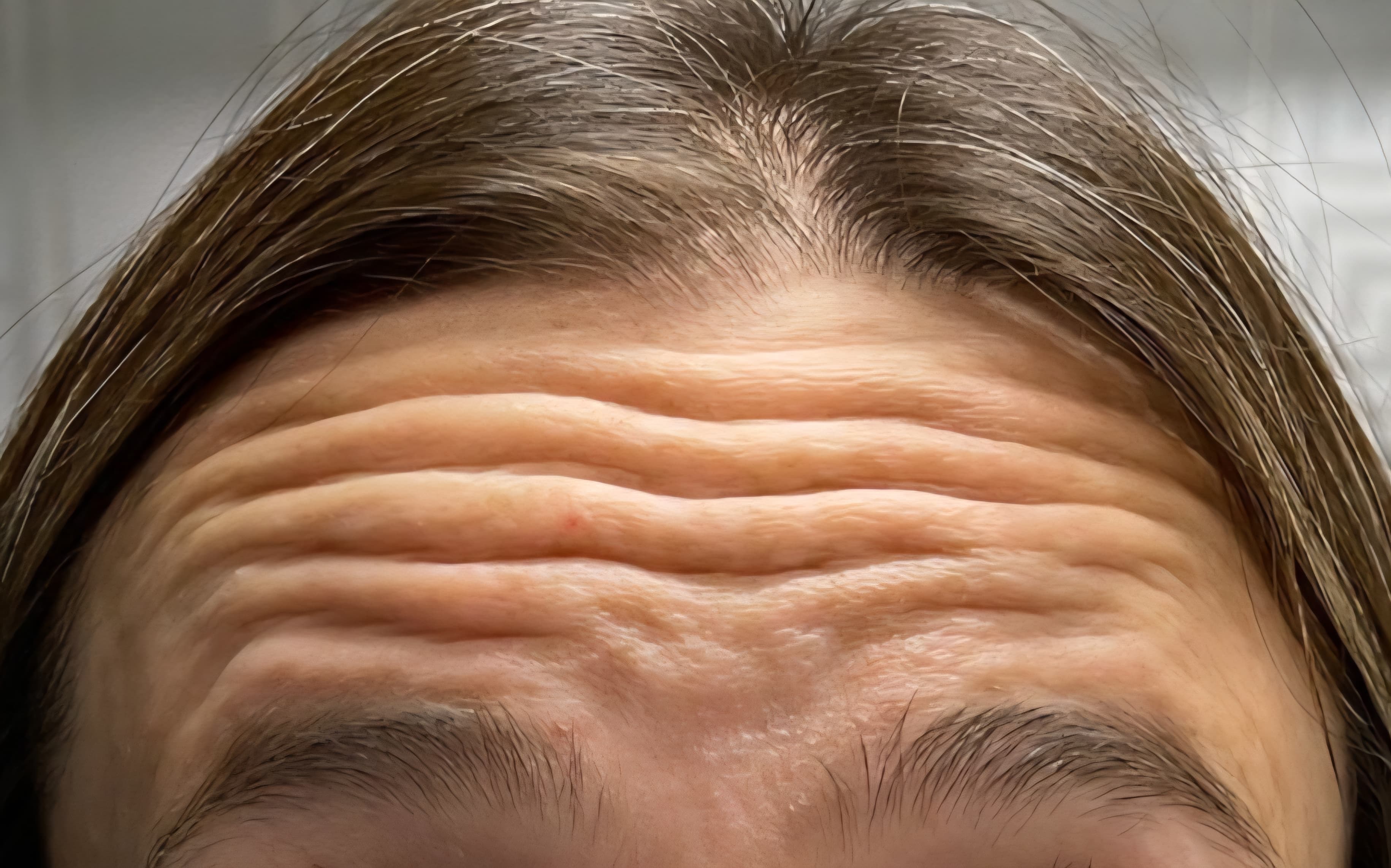 Stirn vor Botulinumtoxin-Behandlung — sichtbare Querfalten